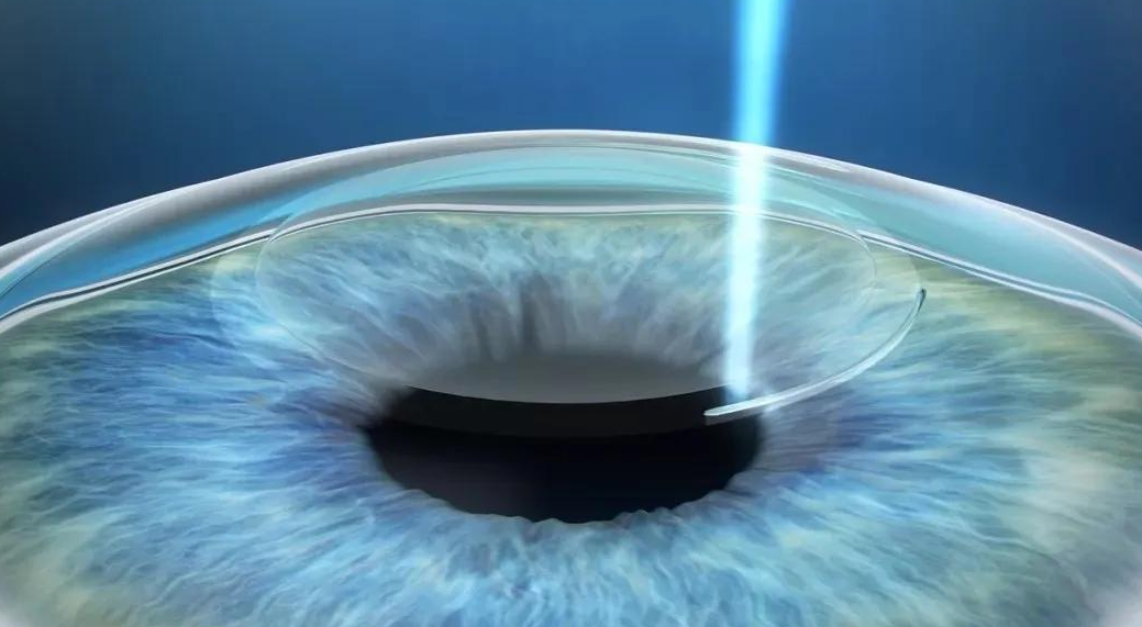 高度近视怎么办?晶体植入手术了解一下