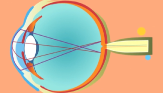 哪种近视手术的方式比较适合你？