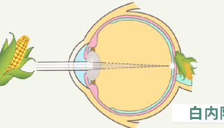 台州白内障专科-白内障相关小知识一览